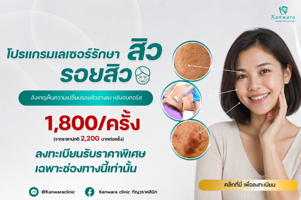 Acne and Spot Laser รักษาสิวใกล้ฉัน
