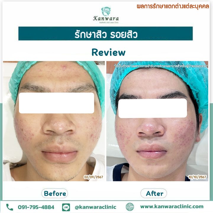 รีวิว รักษาสิว ที่ คลินิกรักษาสิว 68 รีวิว รักษาสิว ที่ คลินิกรักษาสิว 68