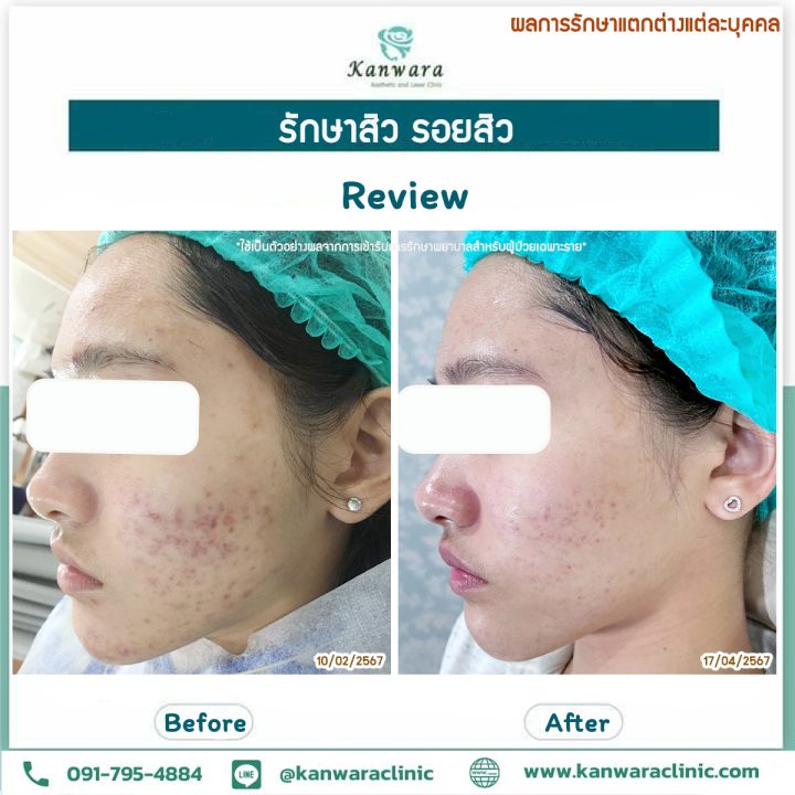 รีวิว รักษาสิว ที่ คลินิกรักษาสิว พุ่กัน 1 รีวิว รักษาสิว ที่ คลินิกรักษาสิว พุ่กัน 1